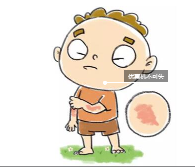 少年兒童患特應性皮炎